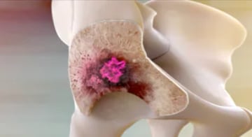 Works at the site of bone metastases Xofigo® works at the site of bone metastases